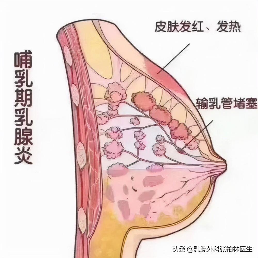 乳腺管阻塞会导致乳腺炎吗？乳腺炎吃什么药？