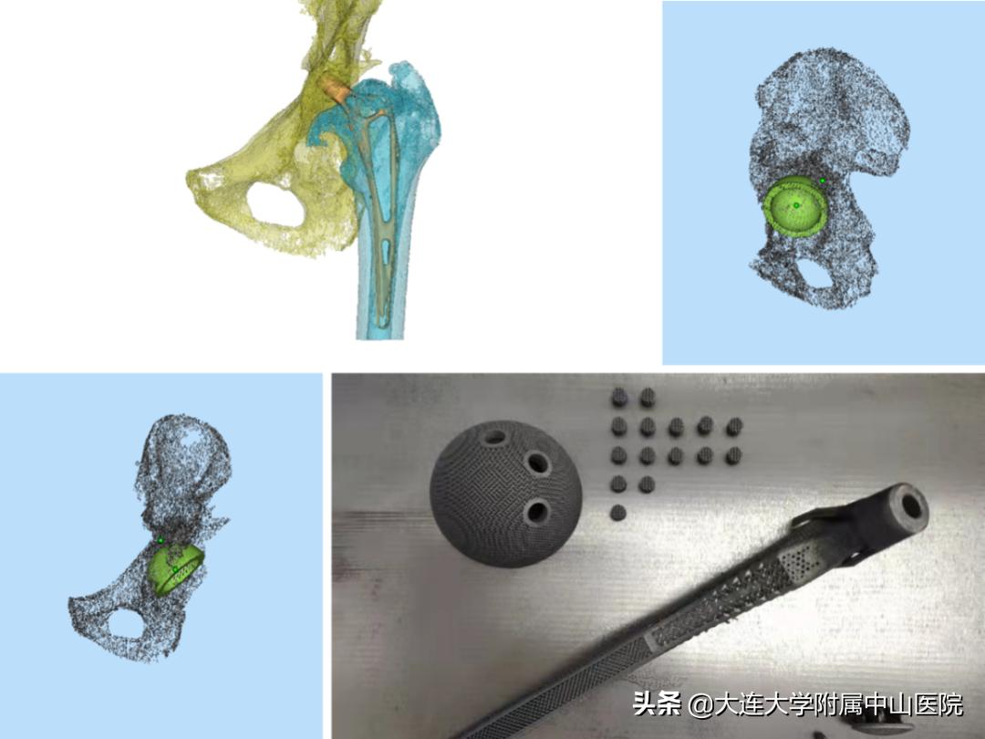 3d打印关节假体,3d打印假体成功案例