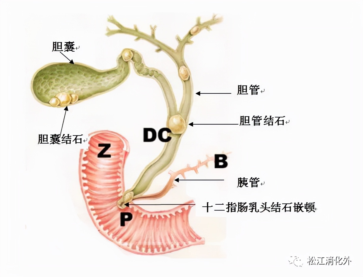 肝内胆管结石饮食禁忌,肝内胆管结石5种自愈的方法