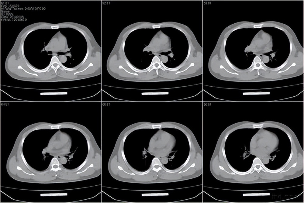双肺上叶局部肺气肿怎么办,怎么治两肺纹理增多