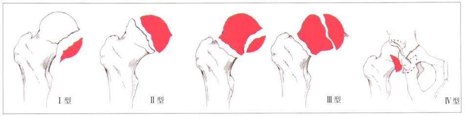 老人股骨头骨折手术,股骨头骨折最佳手术方法