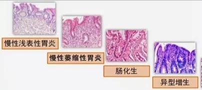 慢性胃炎会发展成胃癌吗?消化科医生为你解读“癌前疾病/病变”