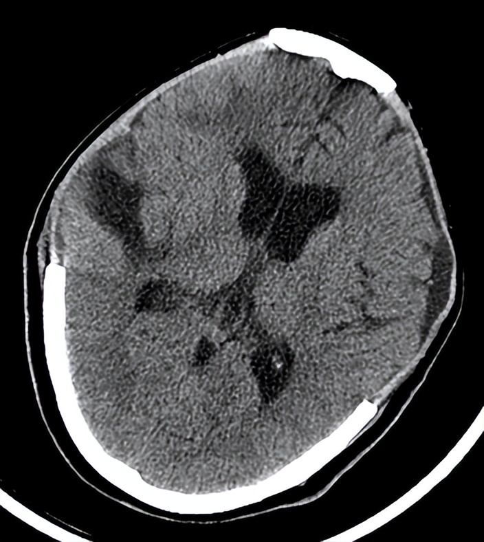医院成功救治重型颅脑患者,特重型颅脑损伤治愈案