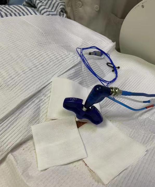 胸椎压缩性骨折微创手术利弊,胸椎压缩性骨折保守治疗20例