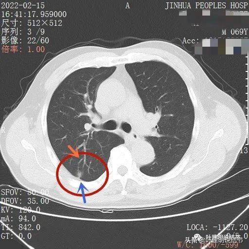 肺腺癌高危亚型什么意思,肺腺癌高危亚型
