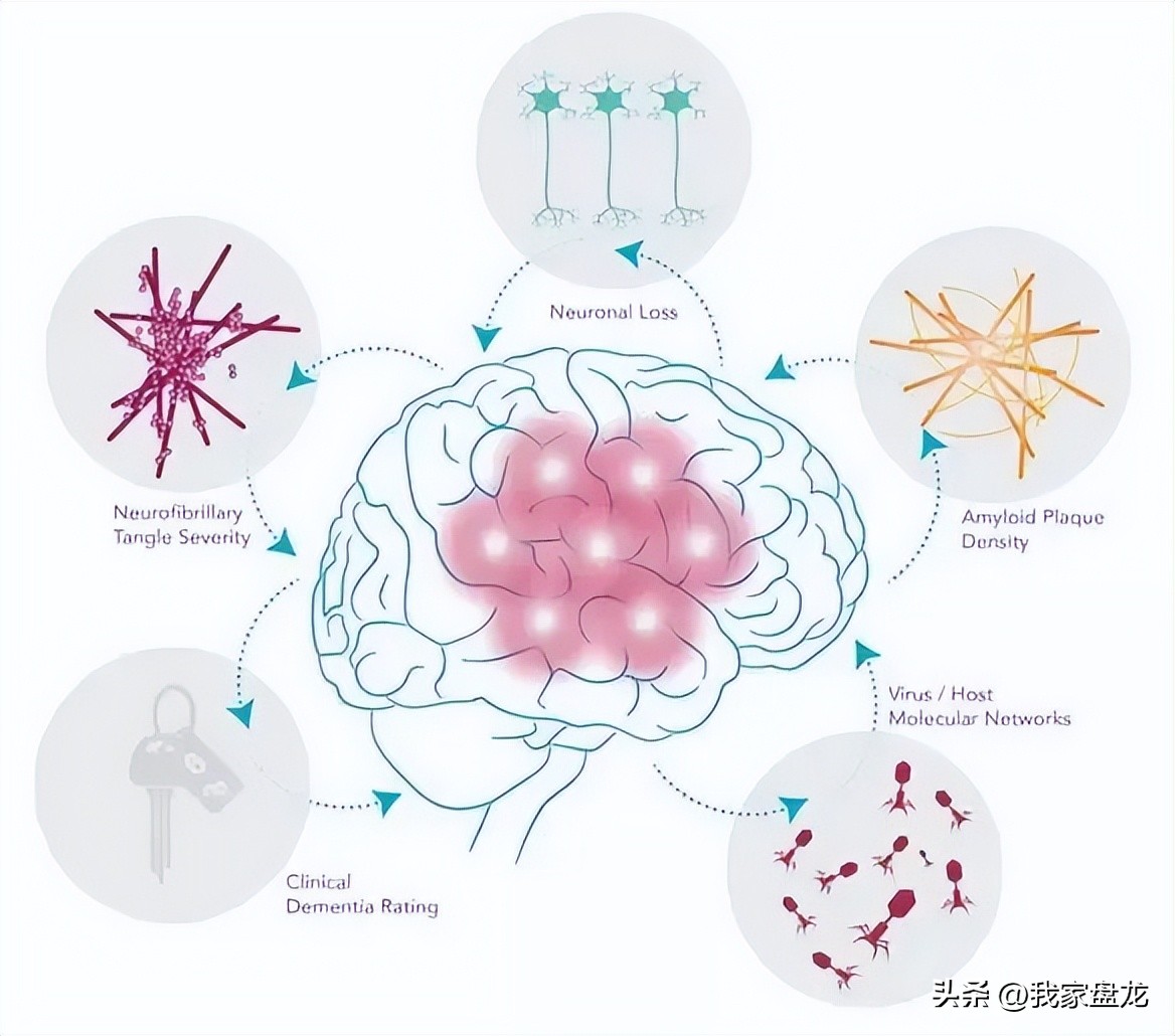 一针带状疱疹疫苗,带状疱疹与老年痴呆的关系