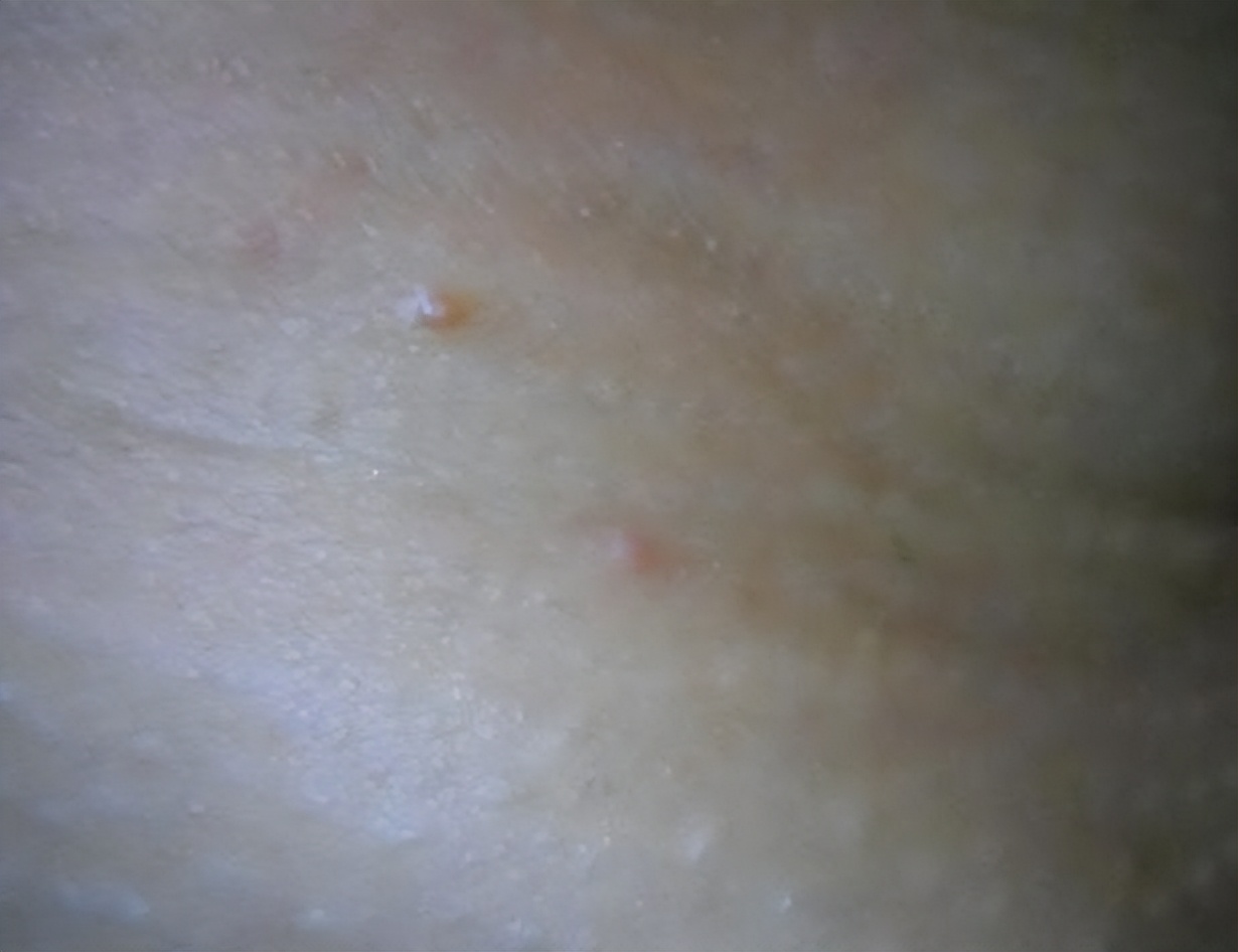 脖子上肉粒可以自己揪掉么,脖子腋下长小肉粒可以用手揪掉吗