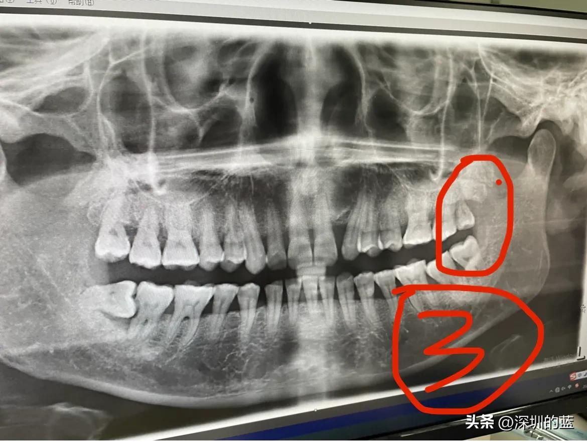 拔除智齿解决了多年的口臭,拔掉四颗智齿意外治好了口臭