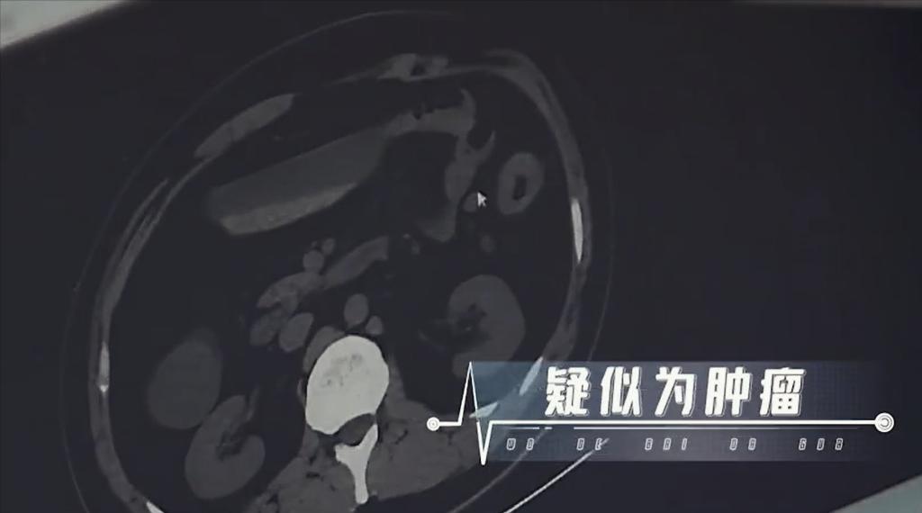 27岁小伙腹痛就医,27岁男子腹痛就医后续