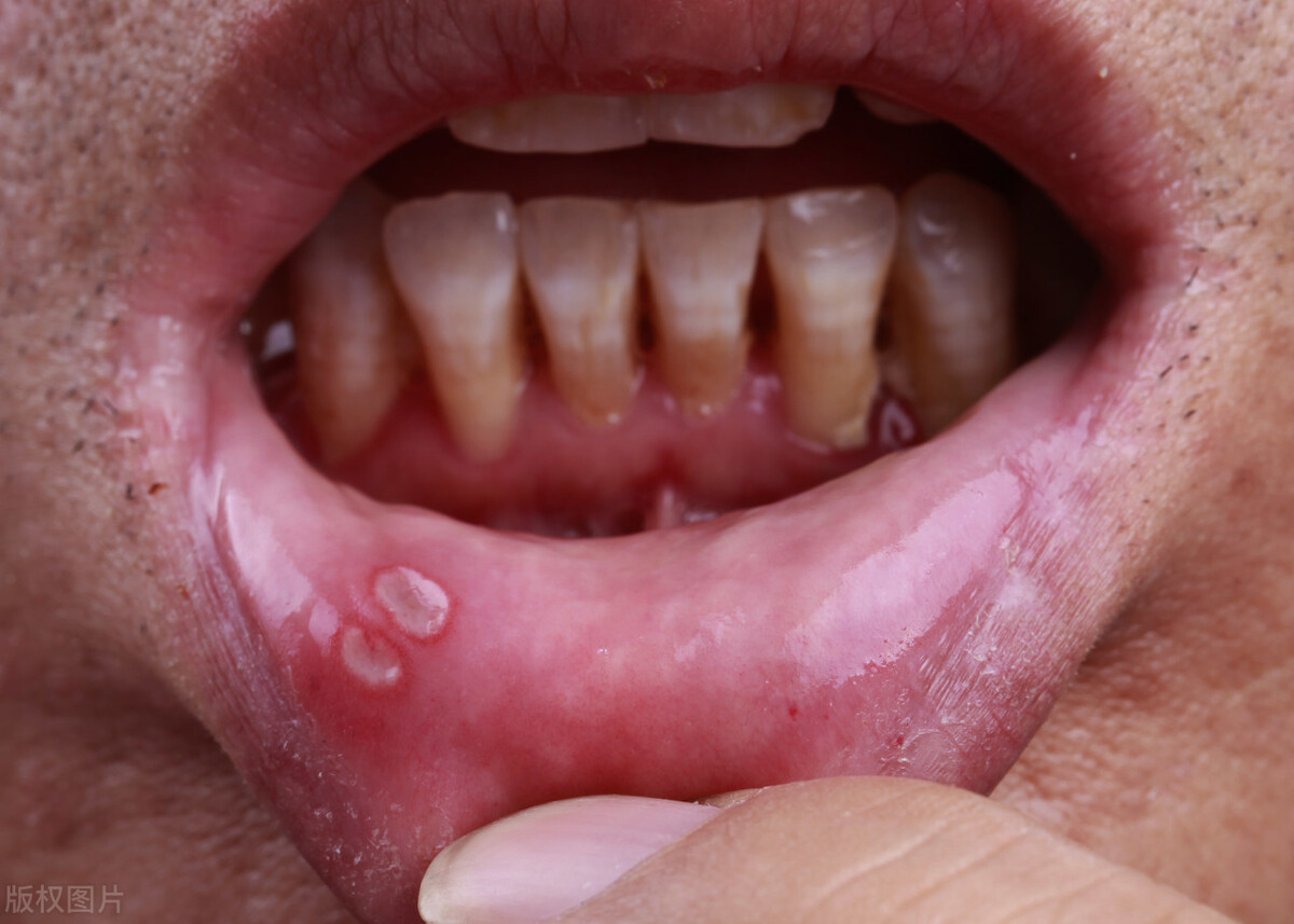 口干口苦口臭教你一招解决,口干口苦口臭是什么原因怎么预防