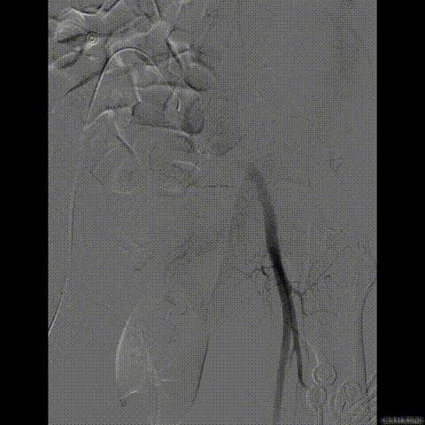 病例回顾与分享,腹膜后血肿介入治疗