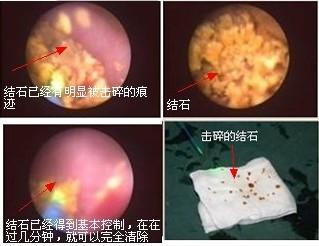 南昌大学二附院系列科普：泌尿系统结石的防治