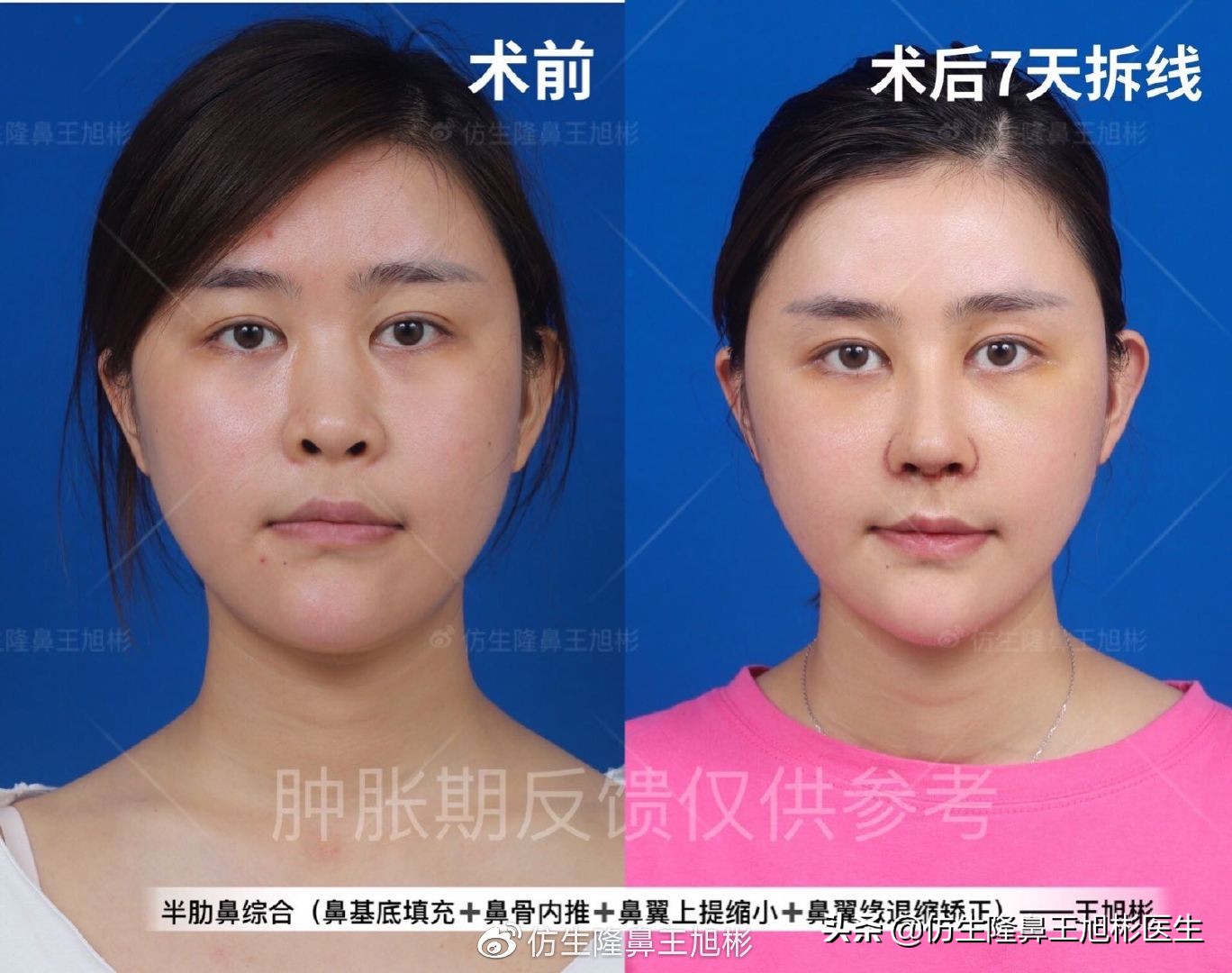 常见鼻部整形美容项目,整形鼻和自然鼻