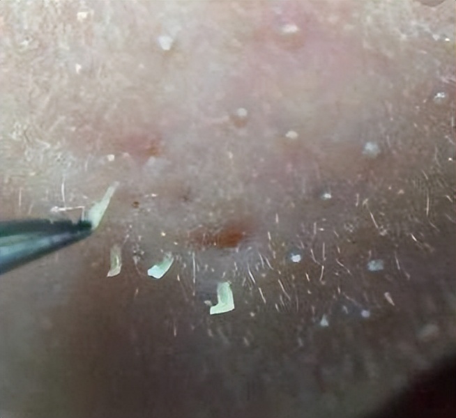 清洁面膜可以去黑头粉刺闭口吗,清洁面膜可以去除黑头吗