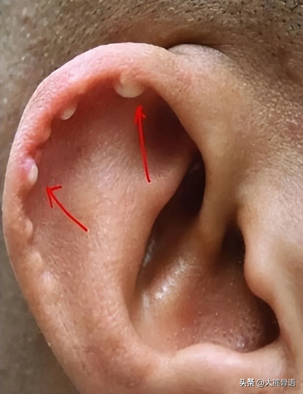 手指痛风的初期症状和治疗,脚踝痛风的症状和治疗方法