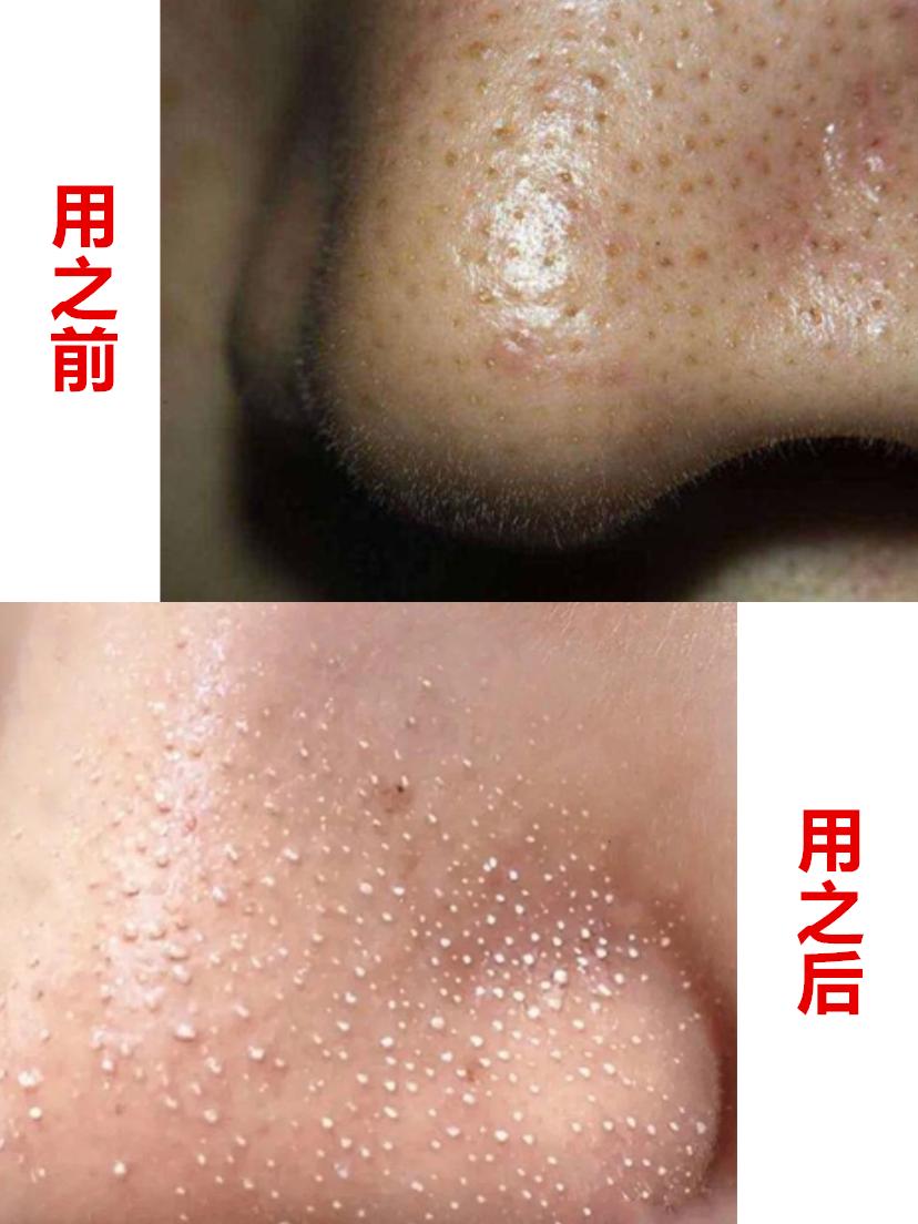 鼻子上好多黑头把毛孔堵住了,鼻子上的黑头怎么去除最有效方法