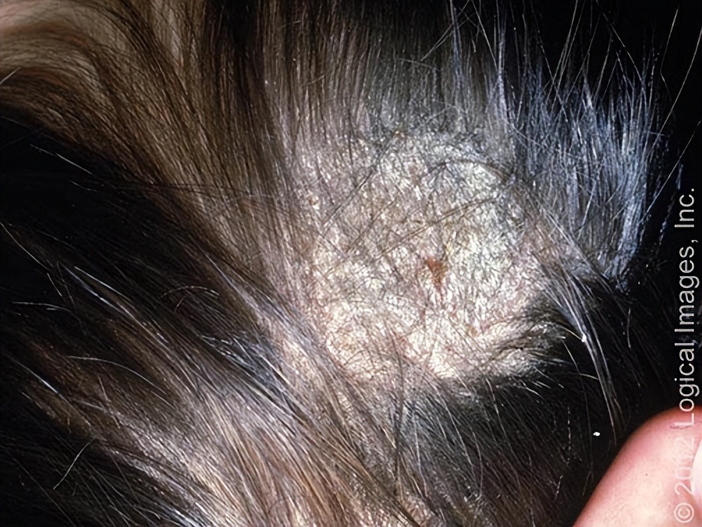 指甲抓头皮有白色的泥,头皮总能抠下来白泥