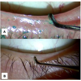 清水洗眼睛保护眼睛,清洗眼睛的护理方法