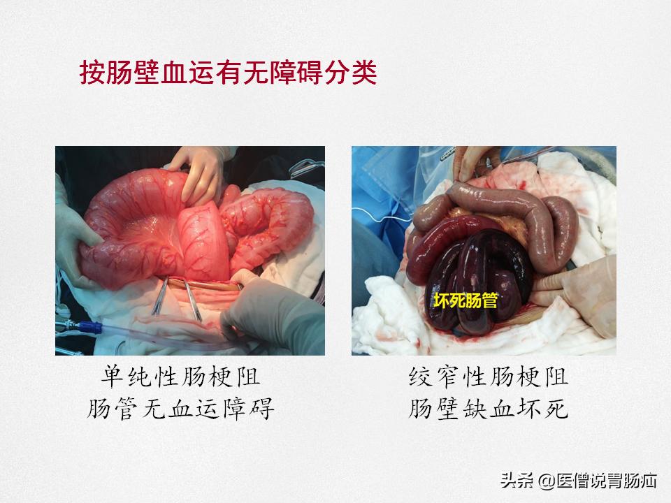 肠梗阻健康教育,肠梗阻患者的健康宣教