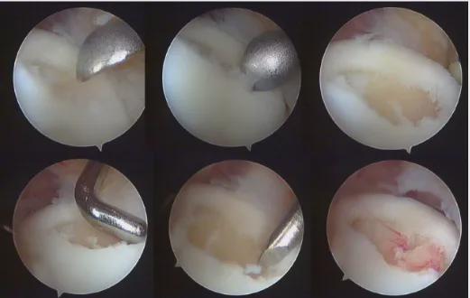 踝关节软骨损伤与踝关节炎区别,踝关节距骨软骨损伤怎么保护的