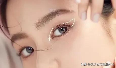 提眉术加开眼角,泡泡眼提眉术