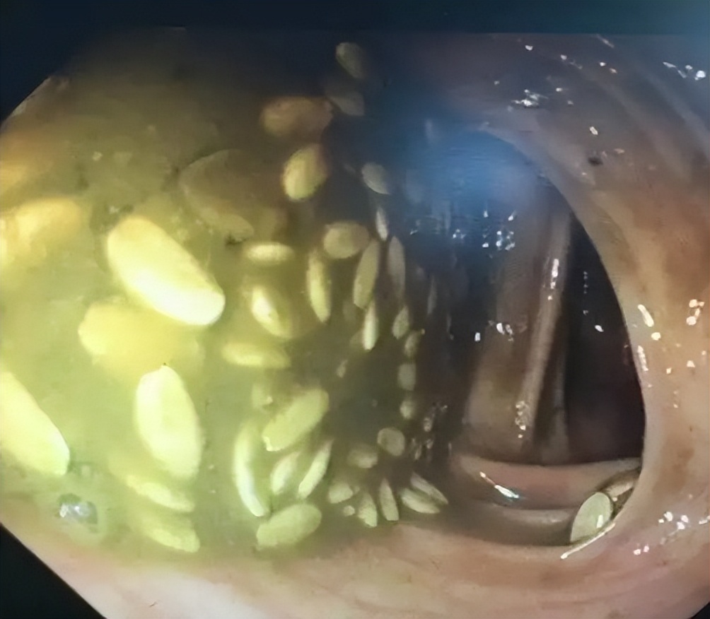 肠道准备不满意影响视野,肠道准备不充分肠镜会漏诊吗