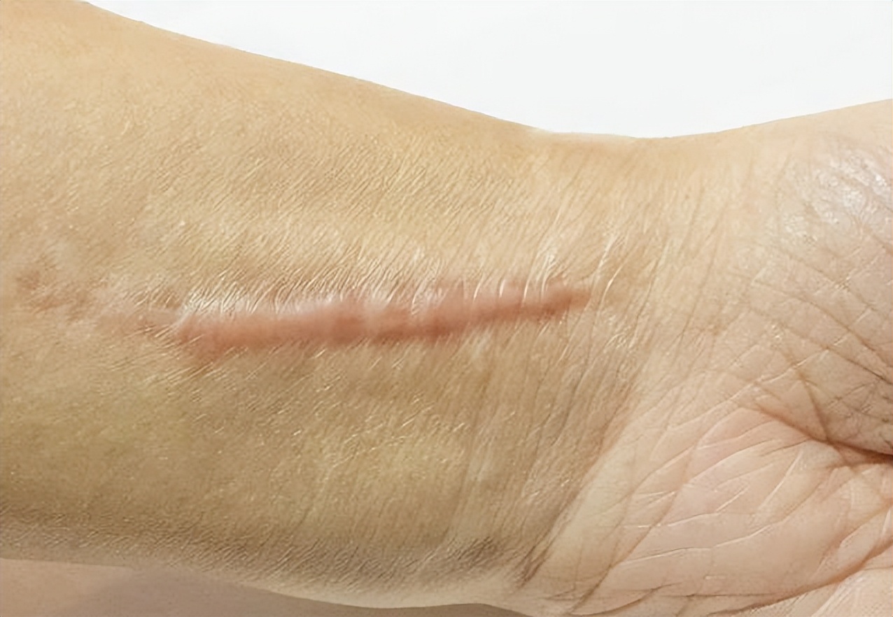 术后出现疤痕增生怎么办?正确选择祛疤药膏,让疤痕变淡变小