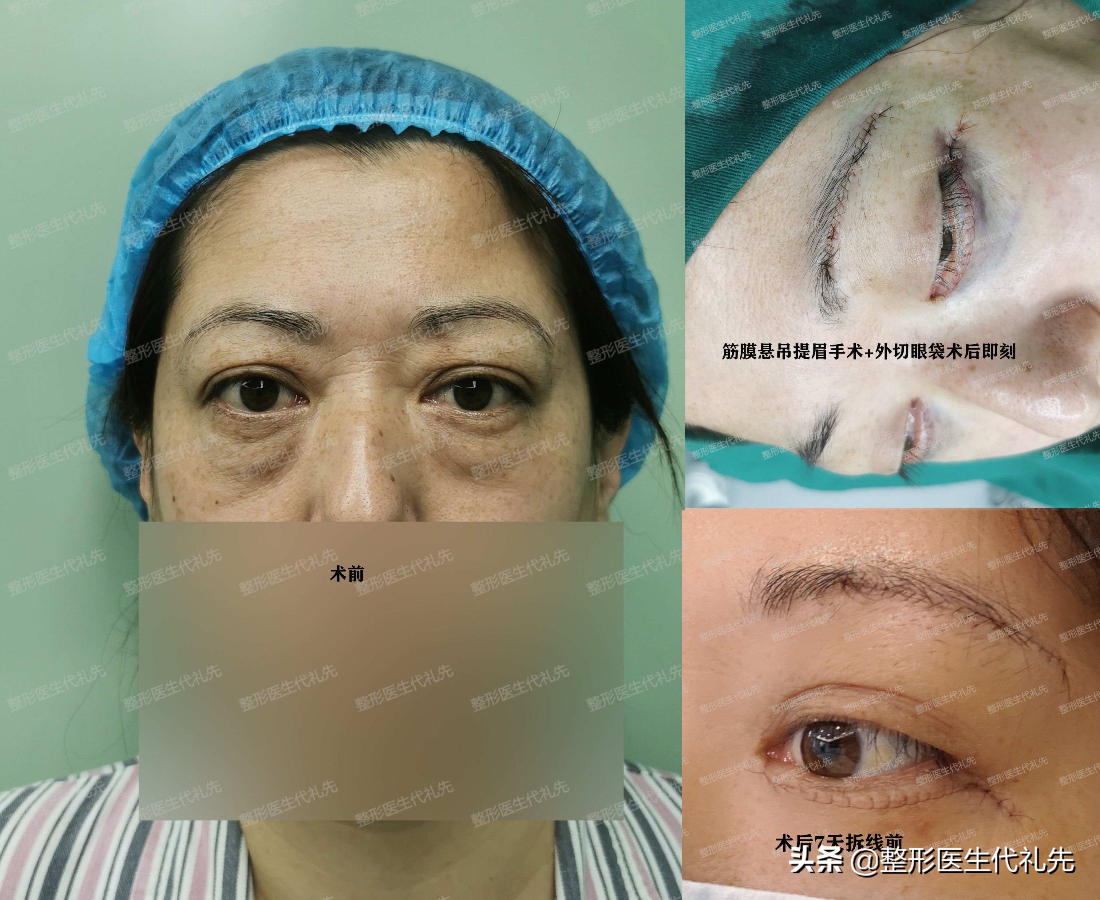 眼下细纹除皱教程,眼下细纹怎么去除做手术