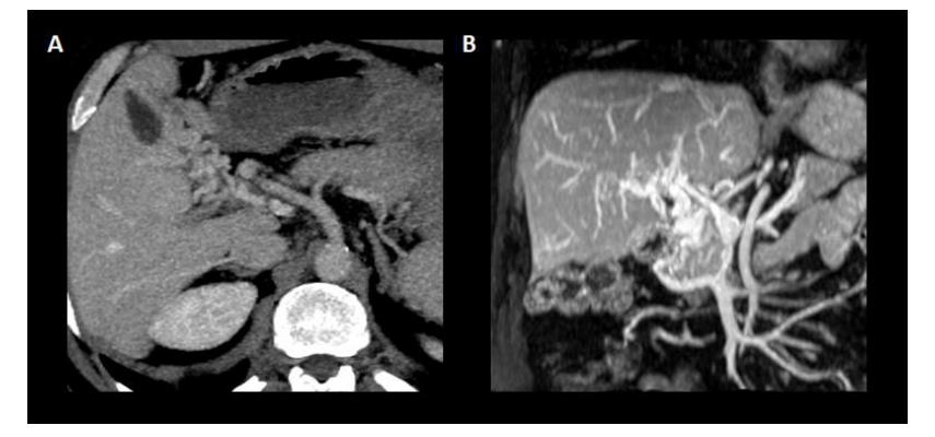肝硬化伴有门静脉血栓介入治疗,肝硬化门脉血栓相关文章
