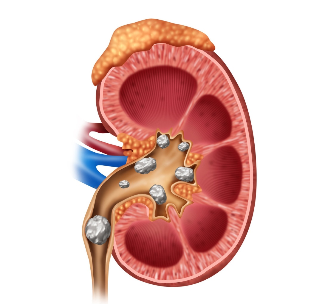 肾结石会引起背疼吗,肾结石是什么引起的