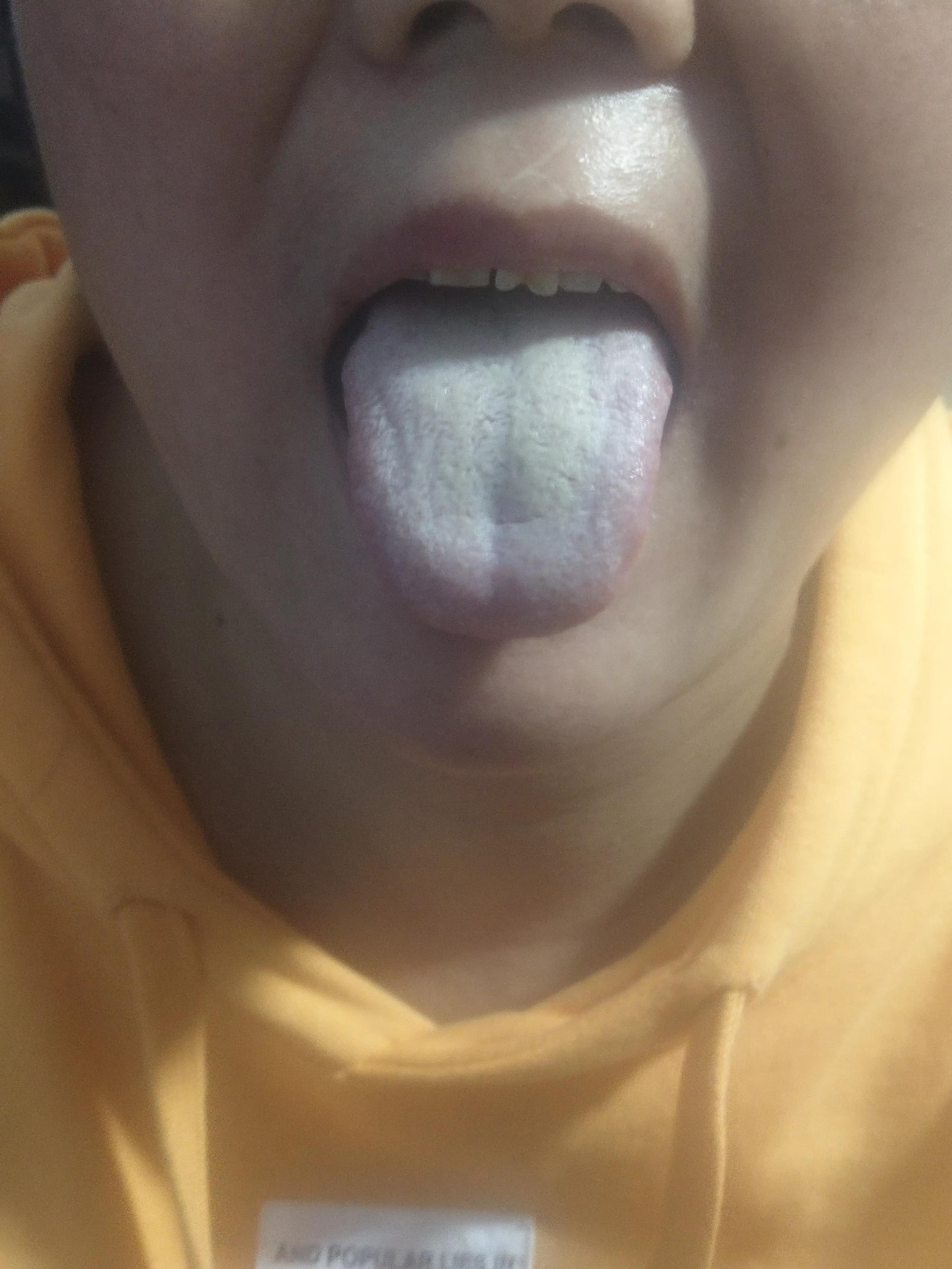 滋阴活血祛舌苔厚腻,滋阴舌苔就变白了