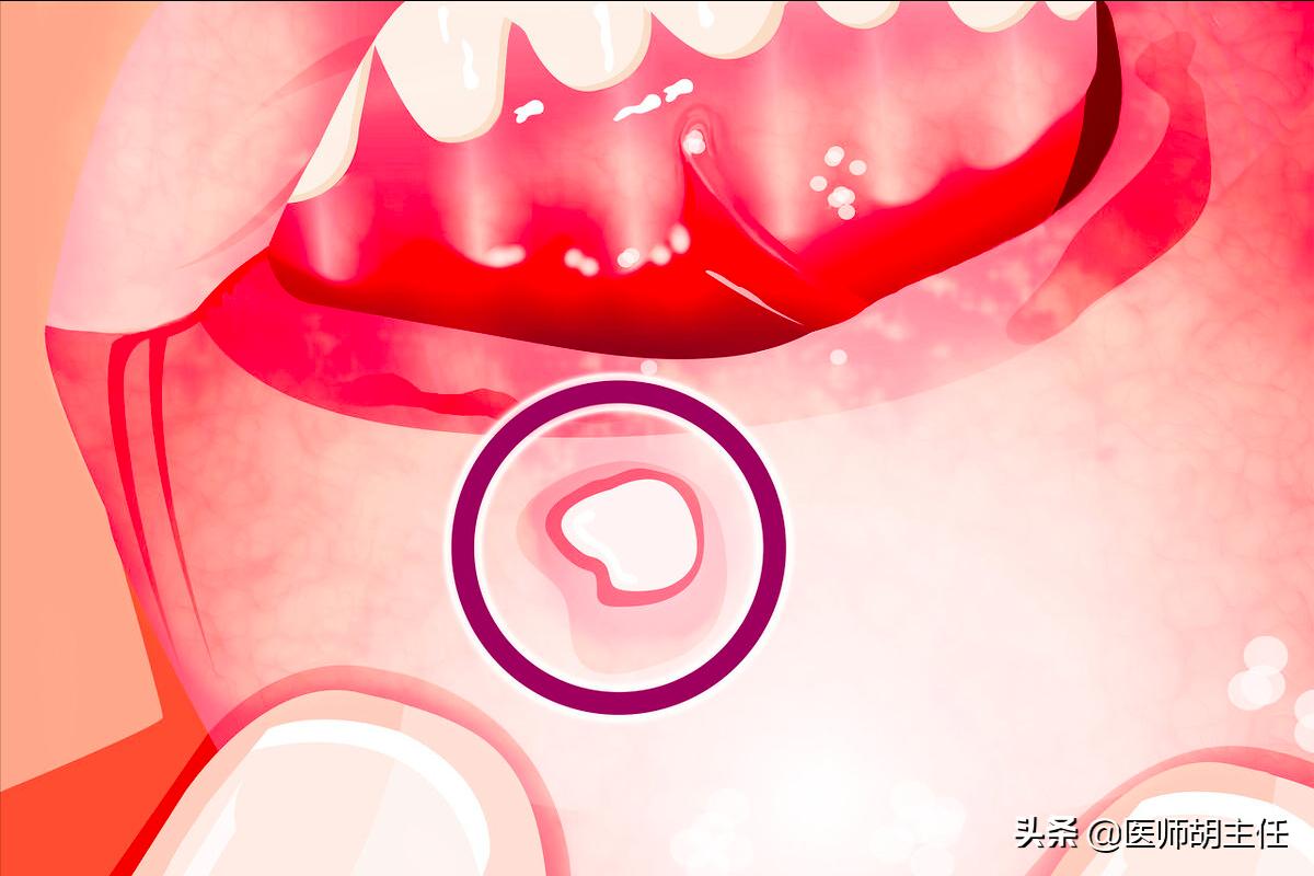 口腔溃疡为什么要吃维生素来治疗,缺乏维生素口腔溃疡应该吃什么药