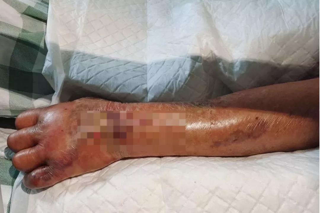 被鱼刺到手虾刺感染细菌截肢,手被河里的鱼刺伤会感染什么细菌