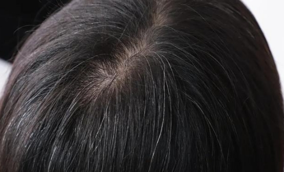 头发经常白发是因为什么,头发频繁出现白发怎么回事