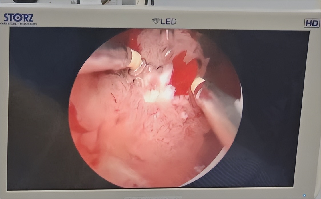 膀胱癌的诊断与鉴别诊断,膀胱癌的诊断与治疗