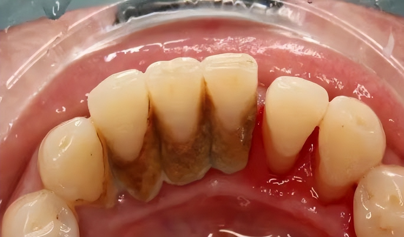 洗牙牙缝变大的原因和解决方法,牙缝特别小怎么洗牙