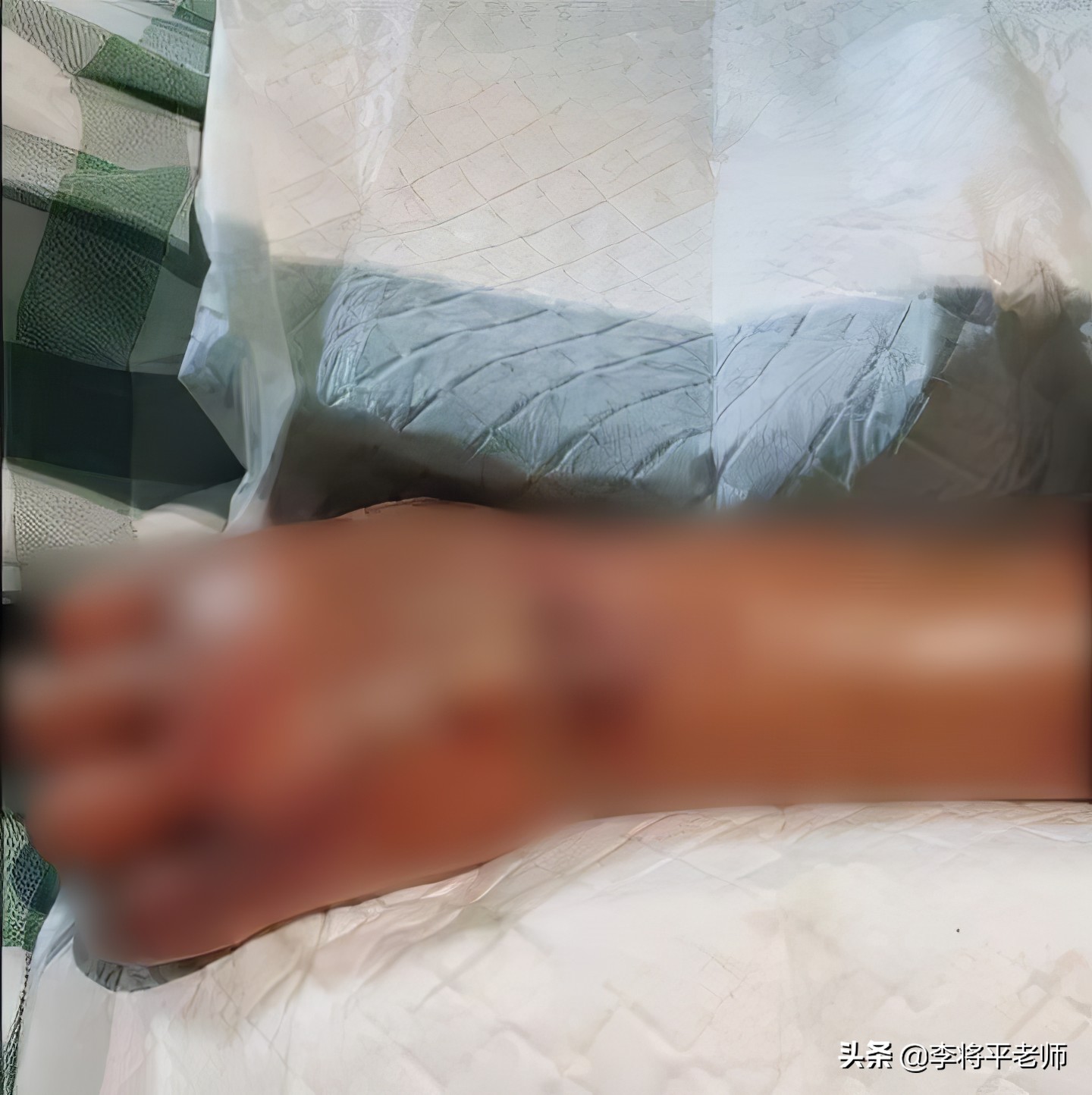 女子被河虾刺到导致截肢,被河虾扎手截肢