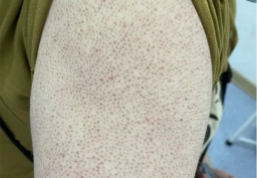 身上很多鸡皮疙瘩怎么回事,身上出现鸡皮疙瘩是什么原因