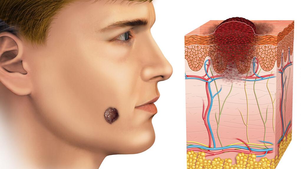 痣越长越大就是癌症的可能吗,长在4个部位的痣与癌症息息相关