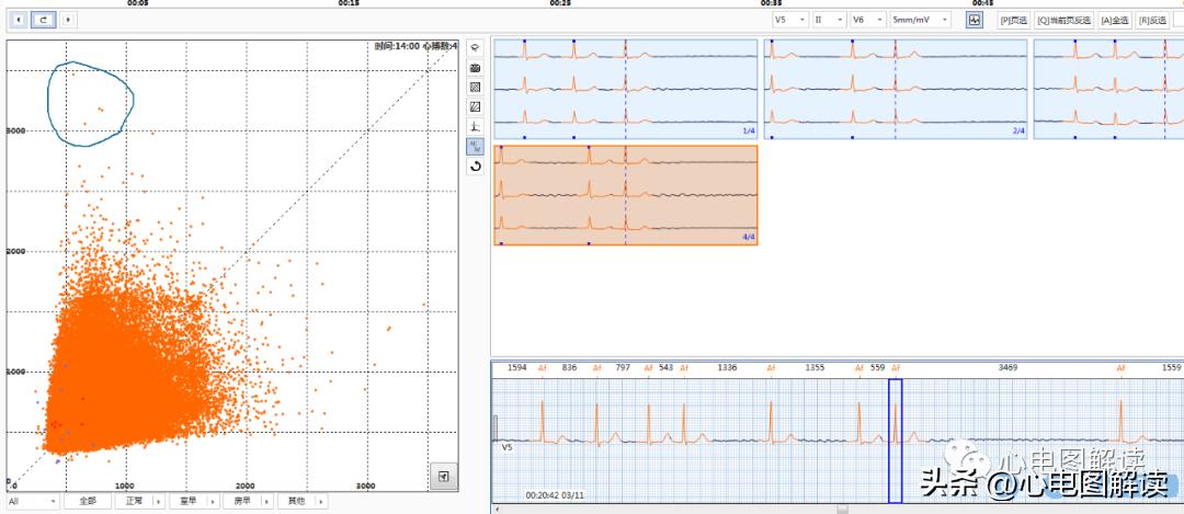 心房颤动伴长间歇能做射频消融吗,心房颤动伴停搏严重么