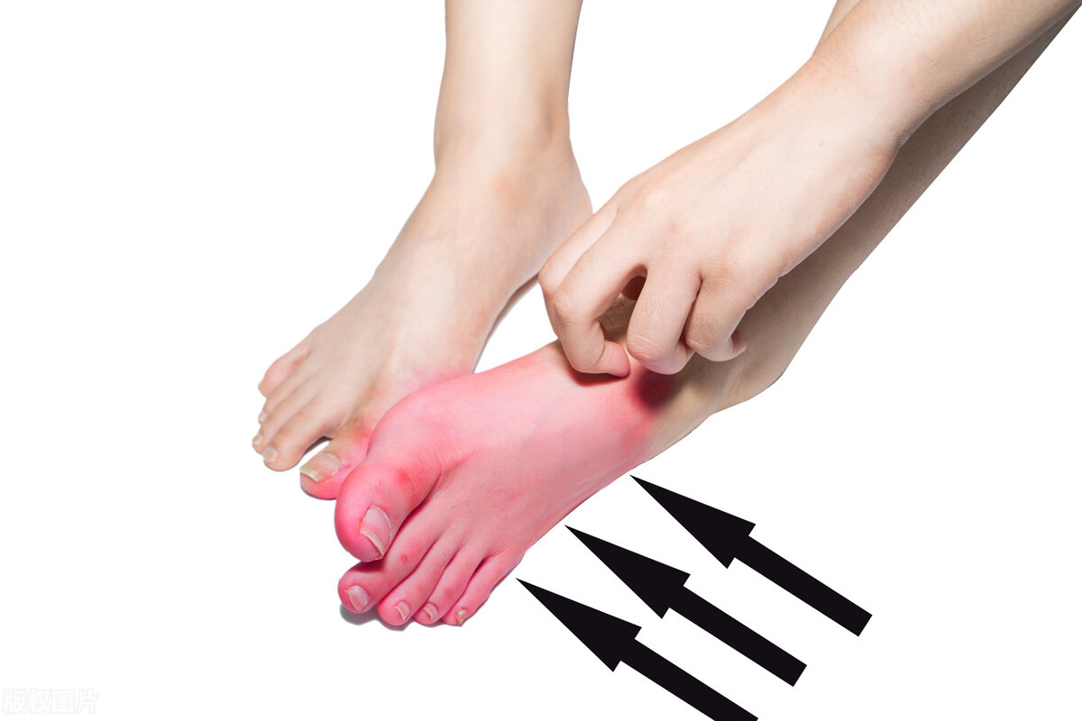 灰指甲的治疗方法根除,灰指甲的中药治疗方法有哪些呢