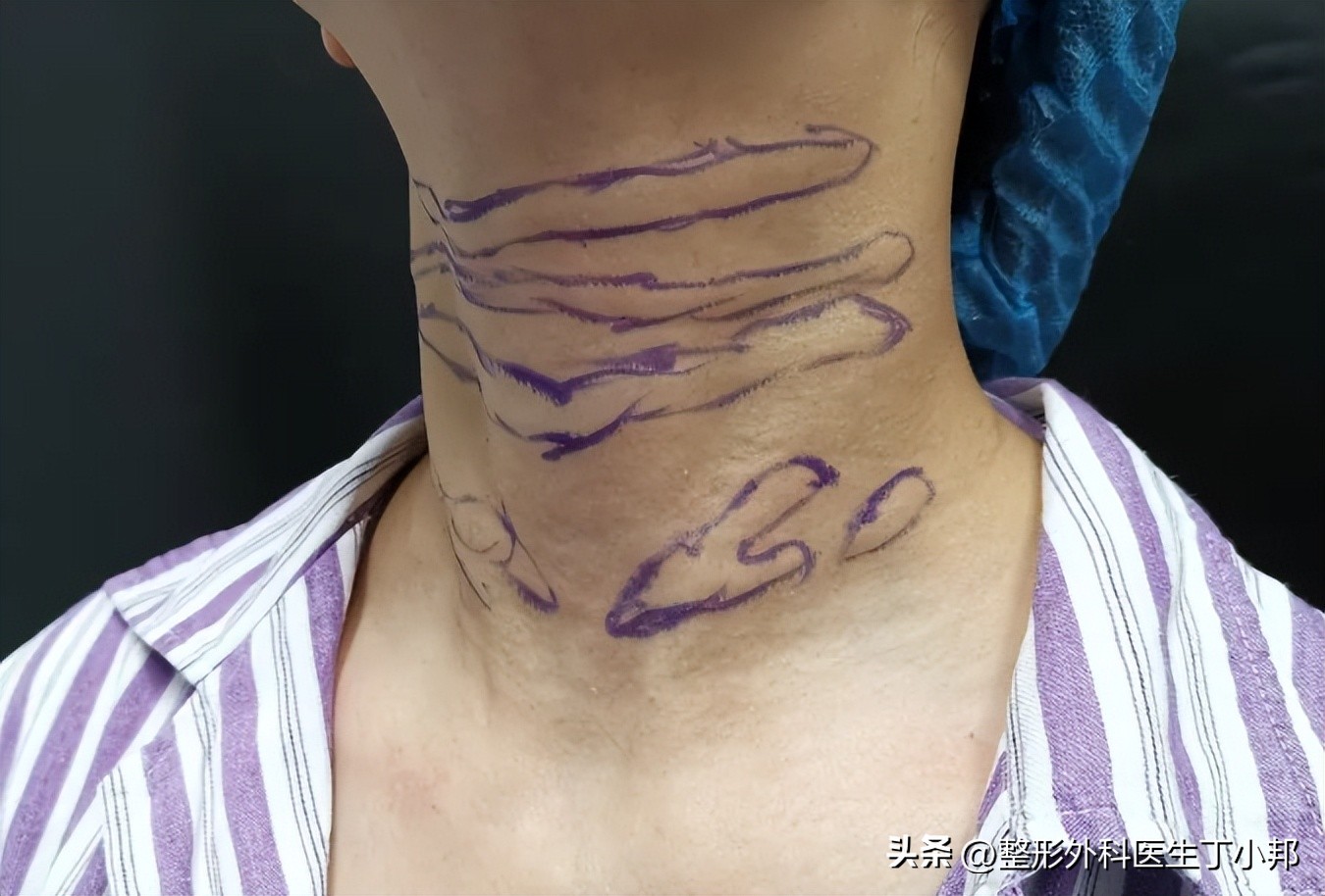 填充颈纹后变白色条怎么消除,颈纹玻尿酸填充