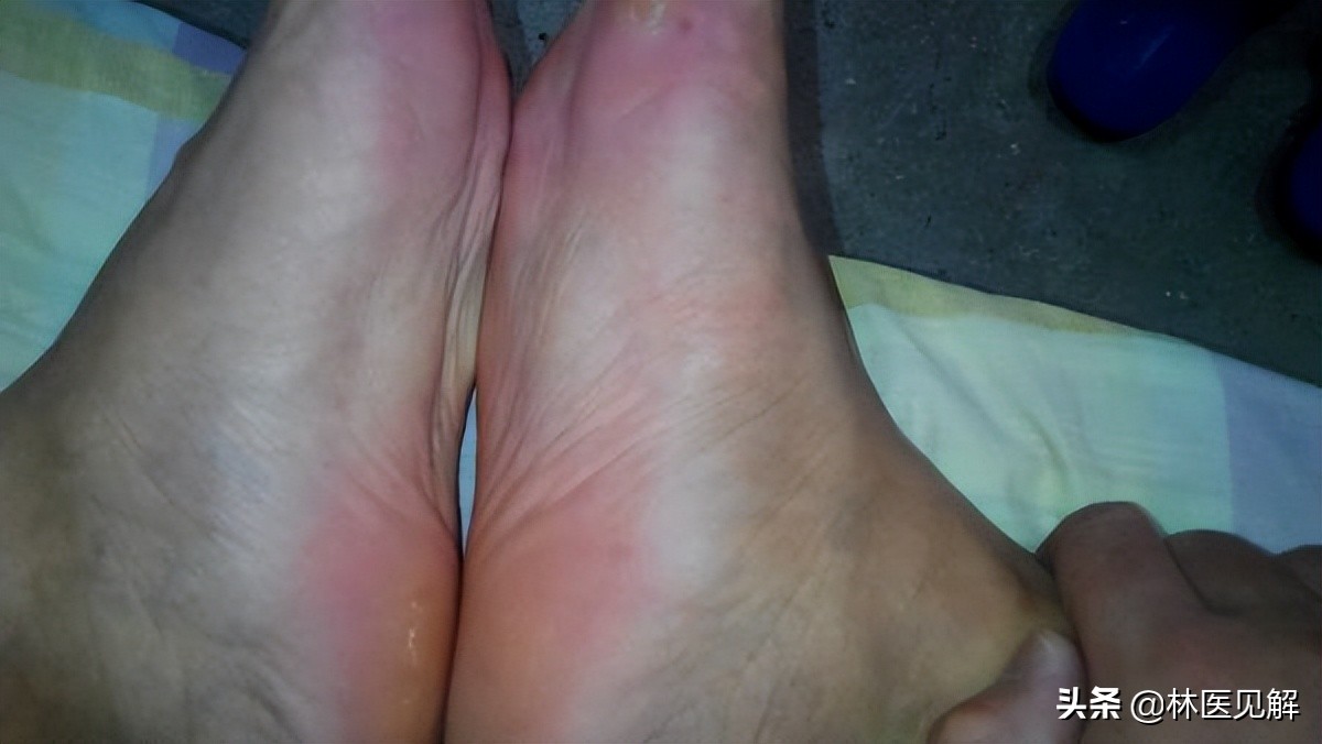 手足心热入睡困难吃什么药,治疗手足心热思路