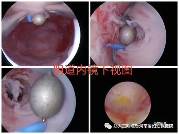 高危hpv1652自己转阴的概率是多少,hpv高危82型感染了三年了还未转阴