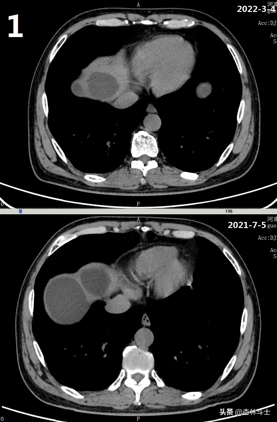 64岁银行职员患肝囊肿，CT引导下细针穿刺抽吸酒精硬化解决大问题