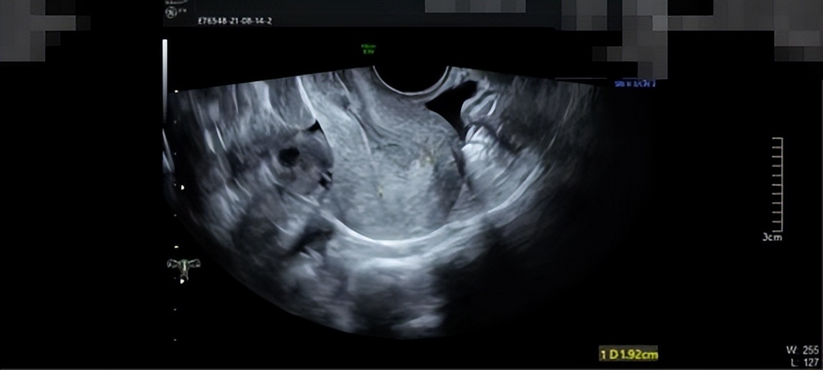 子宫内膜癌的阴道出血症状,子宫内膜癌阴道出血症状