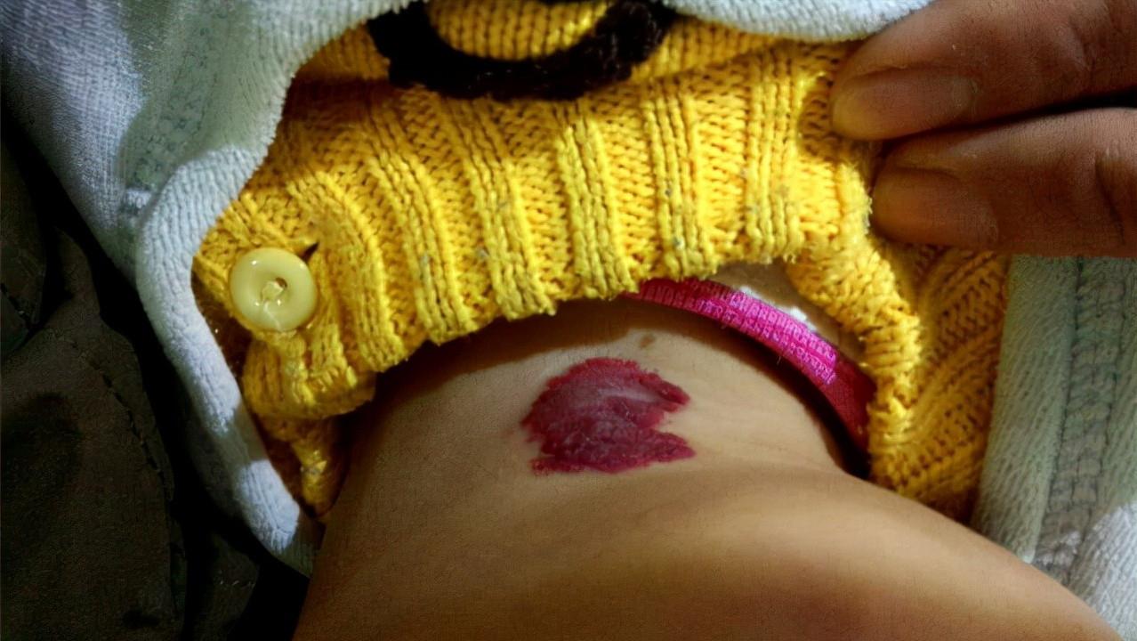 小孩身上的红痣可能是血管瘤,幼儿身上小红点富贵痣竟是血管瘤