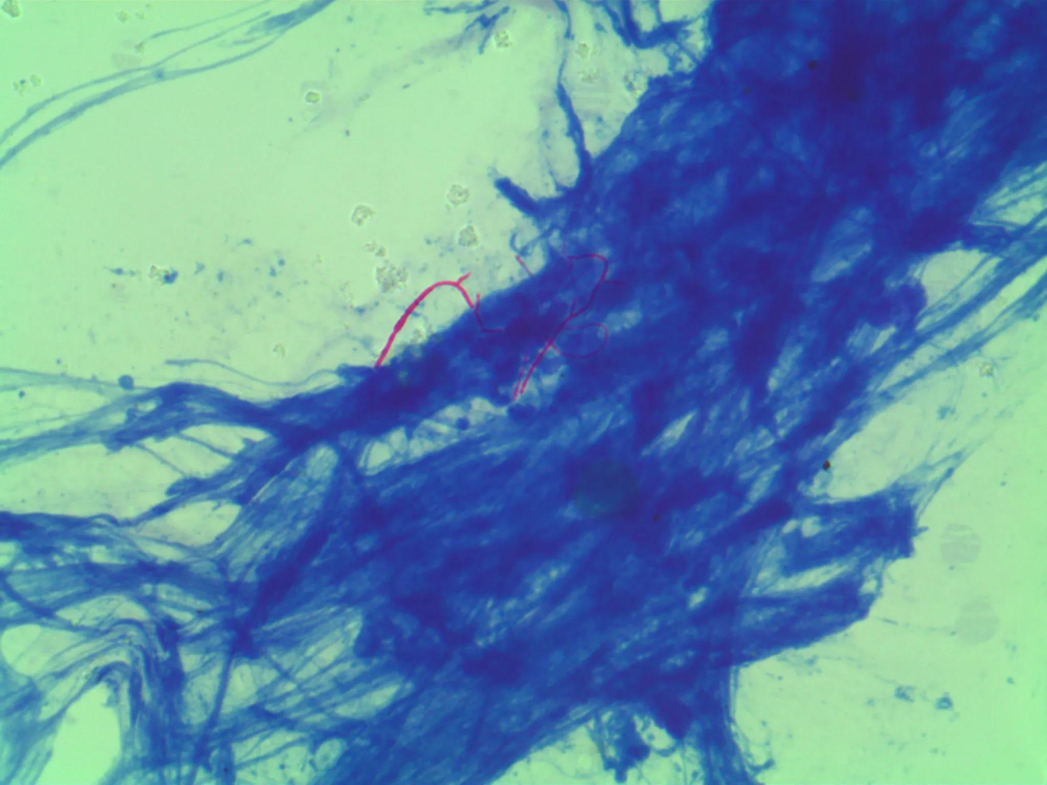 奴卡菌和结核菌,奴卡菌属于非结核分枝杆菌吗