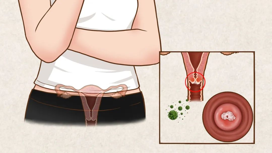 宫颈1级病变怎么治最合适,子宫颈上皮瘤样病变怎么治