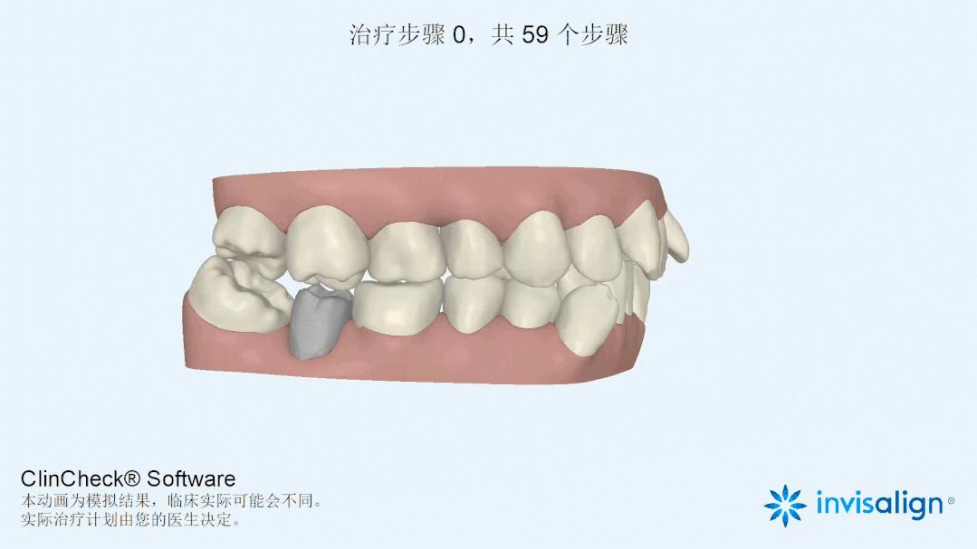 正畸治疗的基本矫治方法,正畸修复联合案例